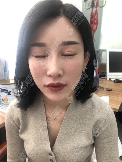 汕头星途整形医院价目表2021,眼修复整形怎么样？内附眼修复整形恢复果图