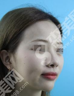 晋城现代女子医院做的隆鼻果怎么样？附医师介绍及案例分享