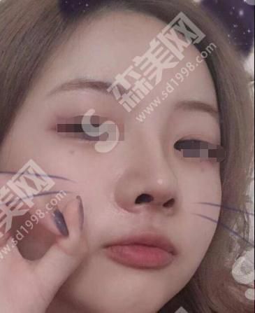 晋城现代女子医院做的隆鼻果怎么样？附医师介绍及案例分享