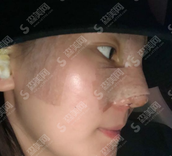 合肥维多利亚医院隆鼻果好吗?自体耳软骨隆鼻有什么优势?附医院简介/医生介绍/案例分享/价格2021