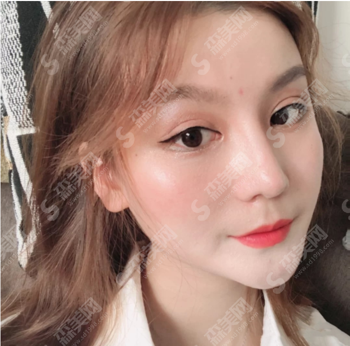 合肥维多利亚医院隆鼻果好吗?自体耳软骨隆鼻有什么优势?附医院简介/医生介绍/案例分享/价格2021