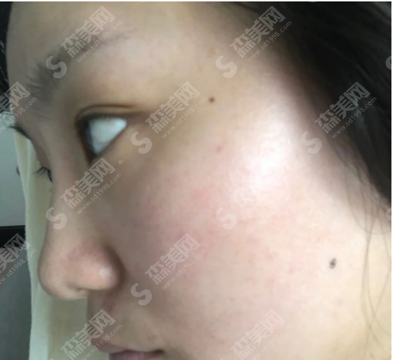 合肥维多利亚医院隆鼻果好吗?自体耳软骨隆鼻有什么优势?附医院简介/医生介绍/案例分享/价格2021