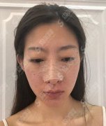 上海伊莱美整形美容医院价目表2021，内含鼻部综合术后果分享