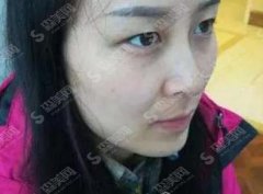 上海割双眼皮较好的专家有哪些?刘菲案例展示+2021价格