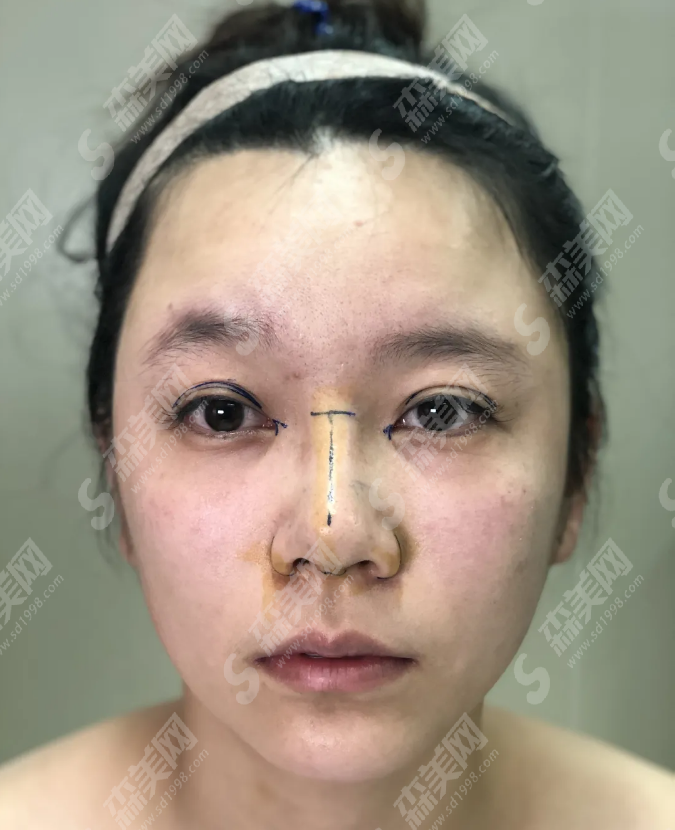 眼部手术&鼻部手术的术后果好吗?附案例分享/恢复过程/注意事项/较新价格一览表2021
