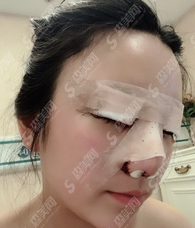 眼部手术&鼻部手术的术后果好吗?附案例分享/恢复过程/注意事项/较新价格一览表2021