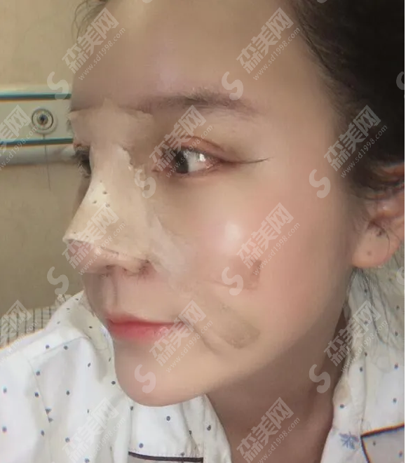 眼部手术&鼻部手术的术后果好吗?附案例分享/恢复过程/注意事项/较新价格一览表2021