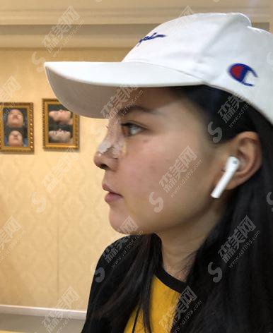 上海星氧整形美容医院隆鼻贵吗？内含肋软骨隆鼻详情分析及整形价目表