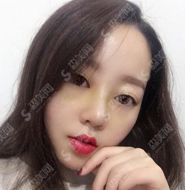 长沙派生医疗美容医院价目表2021，内含假体隆鼻真实案例详情对比