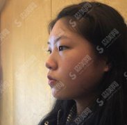 南宁医科大整形美容科价目表2021，内含全切双眼皮的全部过程＋术后果图