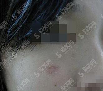 重庆去疤痕哪家医院好?重庆军科医疗美容疤痕去除案例分享