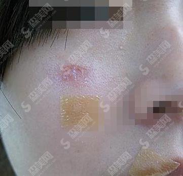 重庆去疤痕哪家医院好?重庆军科医疗美容疤痕去除案例分享