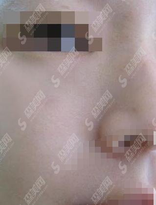 重庆去疤痕哪家医院好?重庆军科医疗美容疤痕去除案例分享