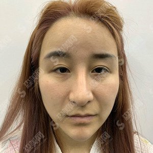 深圳医美整形隆鼻失败修复技术怎么样？内附隆鼻失败修复的康复对比图+较新整形价格