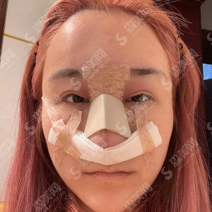 深圳医美整形隆鼻失败修复技术怎么样？内附隆鼻失败修复的康复对比图+较新整形价格