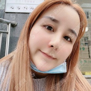 深圳医美整形隆鼻失败修复技术怎么样？内附隆鼻失败修复的康复对比图+较新整形价格