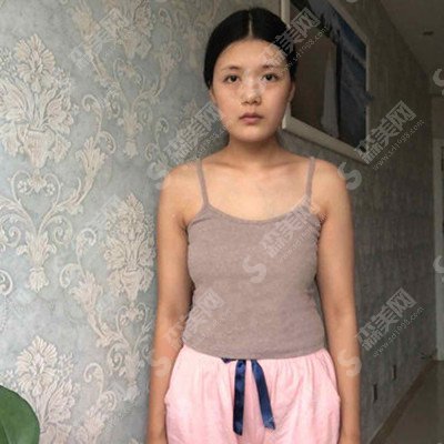 华美整形医院整形价目表2021,隆胸手术怎么样?内附假体隆胸的康复果对比图