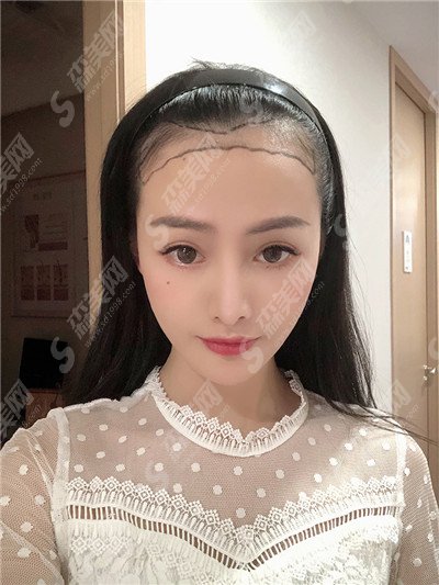 合肥曙光植发价目表2021,加密植发怎么样呢?内附较新植发价目表