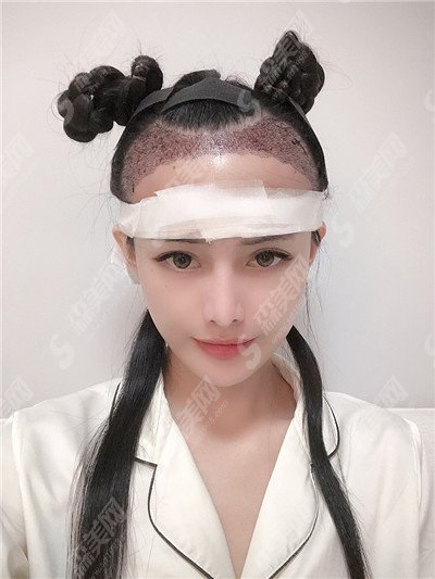 合肥曙光植发价目表2021,加密植发怎么样呢?内附较新植发价目表