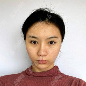 杭州格莱美整形价目表2021,内附面部埋线提升提升案例分享及术后果