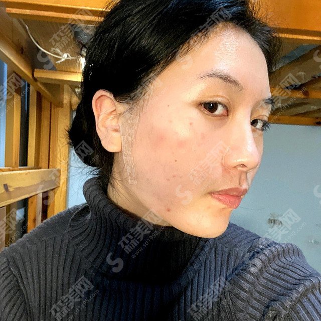 杭州格莱美整形价目表2021,内附面部埋线提升提升案例分享及术后果
