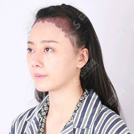 北京植发三甲医院中日友好医院价目表2021,中日友好医院植发技术怎么样?案例分享/医院简介