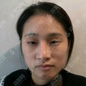 成都圣丽整形医院价目表2021,双眼皮怎么样？内附双眼皮的恢复果图