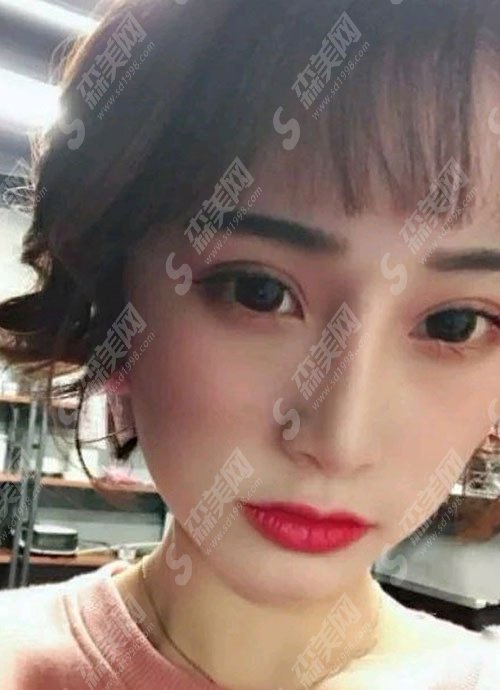 成都圣丽整形医院价目表2021,双眼皮怎么样？内附双眼皮的恢复果图