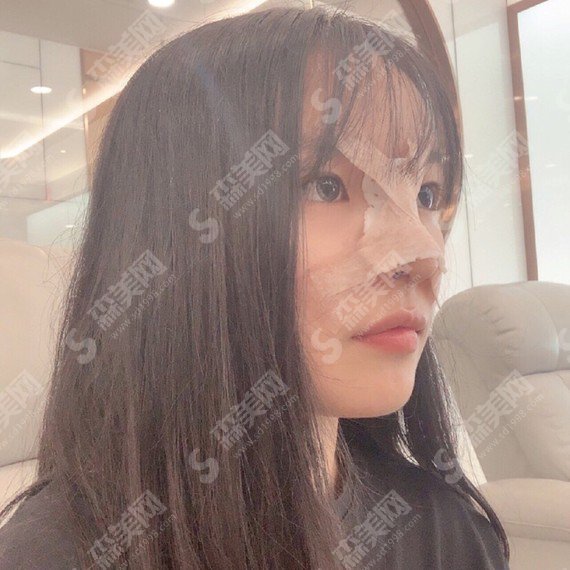 假体隆鼻整形价目表2021版一览&内附假体隆鼻一至7天恢复图