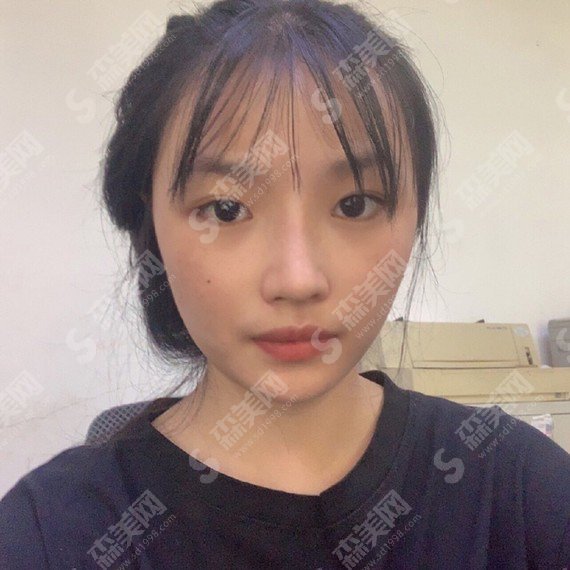 假体隆鼻整形价目表2021版一览&内附假体隆鼻一至7天恢复图