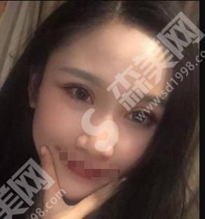 亚韩整形医院做的整形怎么样？附医师介绍及双眼皮案例分享