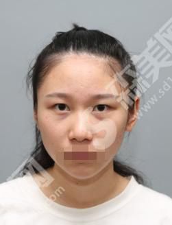 亚韩整形医院做的整形怎么样？附医师介绍及双眼皮案例分享
