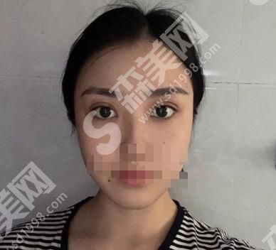 聊城韩美整形医院怎么样?医院医生有哪些?医院双眼皮案例前后对比图