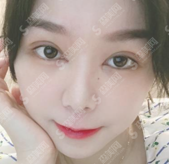 浙江大学医学院第二附属医院整形外科双眼皮术后果怎么样?附案例分享/注意事项/双眼皮整形较新价格表