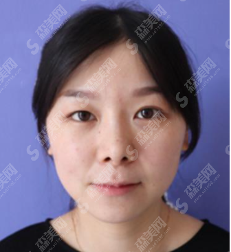 浙江大学医学院第二附属医院整形外科双眼皮术后果怎么样?附案例分享/注意事项/双眼皮整形较新价格表