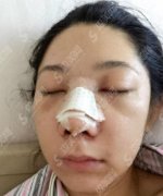 深圳美莱医院价目表2021，内含硅胶隆鼻术后果对比
