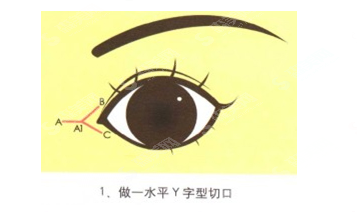 开眼角术没问题吗?手术费用的影响因素有哪些?术后如何护理?附整形价格一览表2021