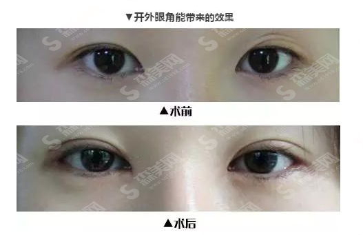 开眼角术没问题吗?手术费用的影响因素有哪些?术后如何护理?附整形价格一览表2021