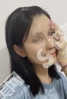 301医院整形科周志强医生做的软骨隆鼻果怎么样?附医师介绍+案例分享