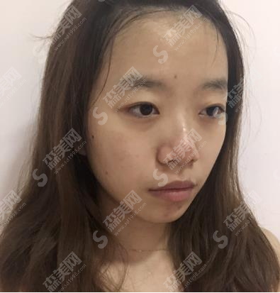 杭州星颜整形医院双眼皮果怎么样?亲述恢复日记+医院介绍+较新价格表