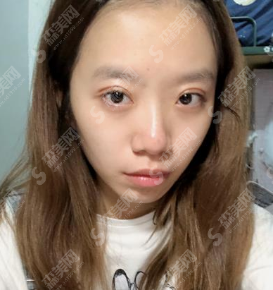 杭州星颜整形医院双眼皮果怎么样?亲述恢复日记+医院介绍+较新价格表
