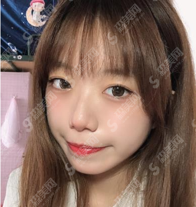 杭州星颜整形医院双眼皮果怎么样？亲述恢复日记+医院介绍+较新价格表