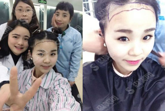 为什么会脱发呢?脱发的典型症状有哪些?植发际线真实案例分享及植发较新价格