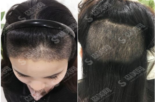 为什么会脱发呢?脱发的典型症状有哪些?植发际线真实案例分享及植发较新价格