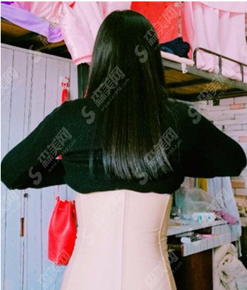 腰腹吸脂案例分享,脂肪堆积的原因有哪些?附术后果及吸脂较新价目表