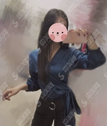 腰腹吸脂案例分享,脂肪堆积的原因有哪些?附术后果及吸脂较新价目表