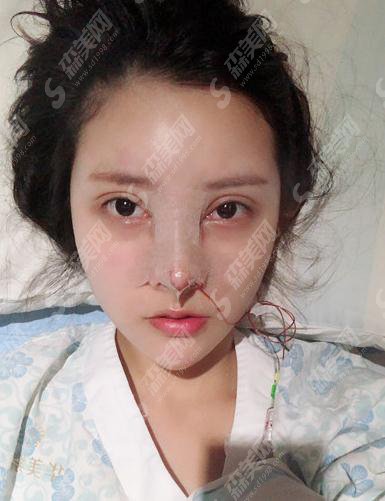 广州健丽医美价目表2021,内含鼻部手术术后恢复果对比