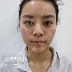 广西正规的整形医院有哪些?隆鼻整形价目表2021/案例分享/医院介绍