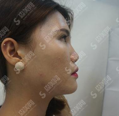 河北省二院整形美容科价目表2021,内含自体肋软骨隆鼻术后恢复分享