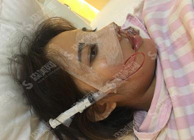 河北省二院整形美容科价目表2021,内含自体肋软骨隆鼻术后恢复分享